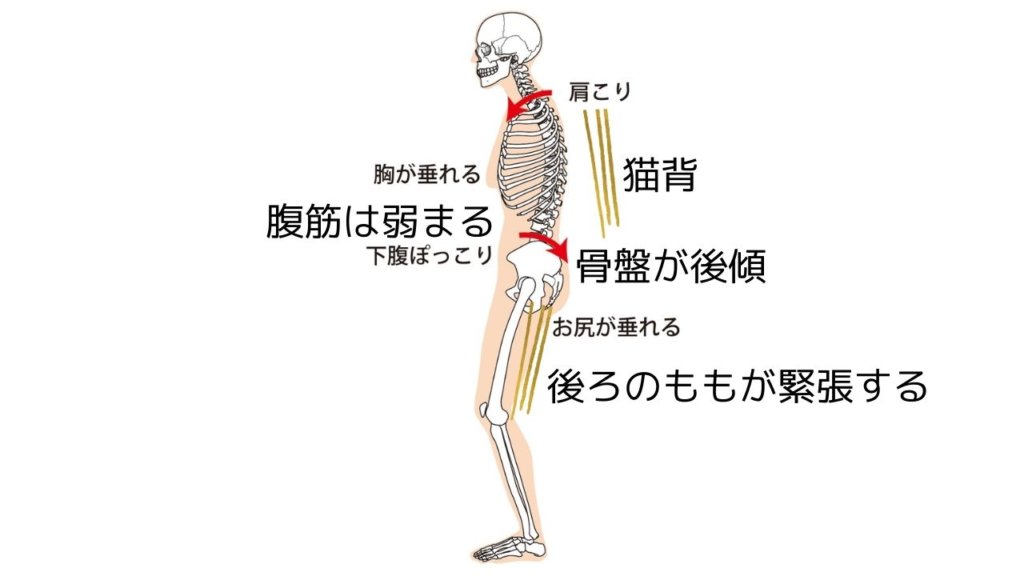 骨盤後傾