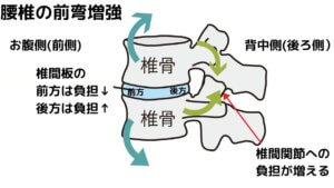 【骨盤前傾】ツラい腰痛！反り腰になっていませんか？