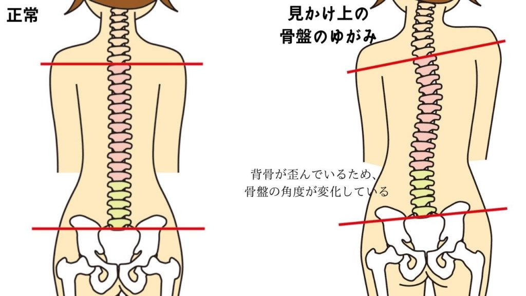 見かけ上の骨盤の歪み