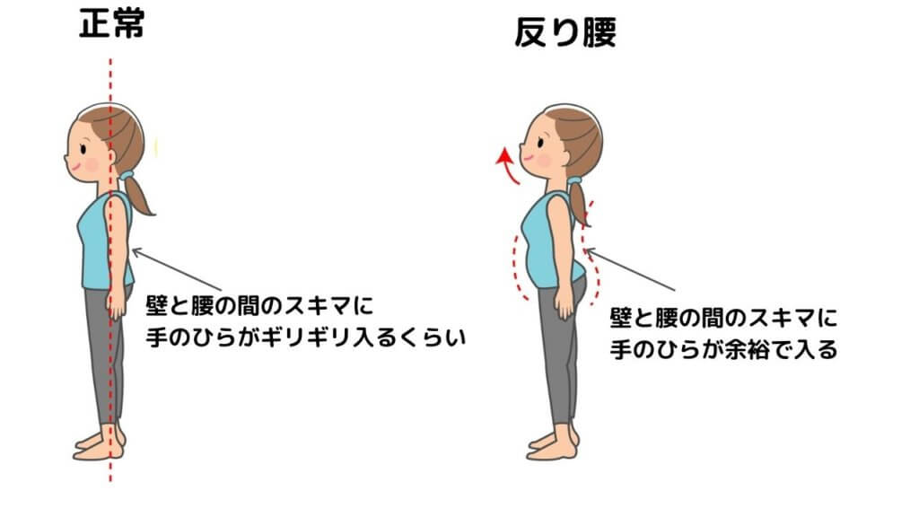 【骨盤前傾】ツラい腰痛！反り腰になっていませんか？