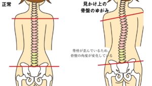 見かけ上の骨盤の歪み