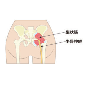 座り過ぎてお尻や脚が痛い・・・梨状筋症候群ってなに？