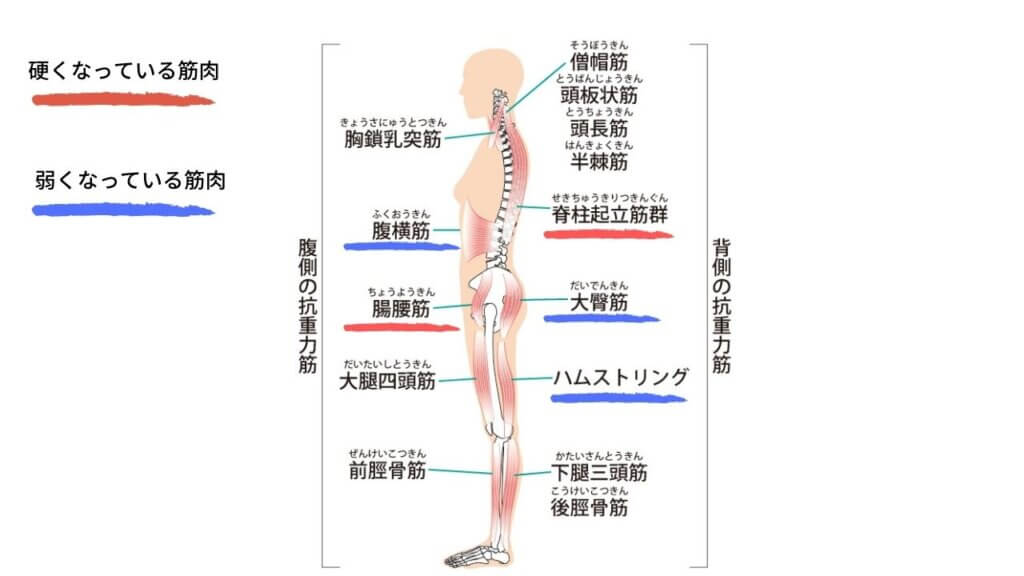 反り腰と坐骨神経痛-5