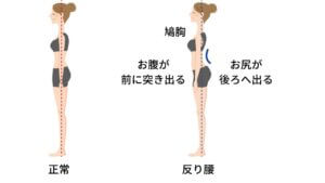 反り腰と坐骨神経痛-2