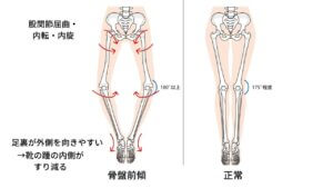 反り腰と坐骨神経痛-3