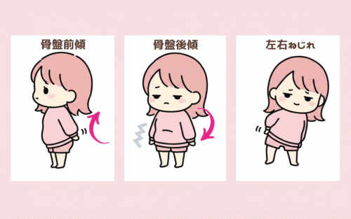 前傾・後傾・左右ねじれの骨盤タイプを、ちいかわ風の女性キャラクターで示したイラスト