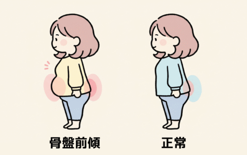 骨盤の傾きと下腹ぽっこりの関係を示す、ちいかわ風テイストの女性キャラクターの比較イラスト