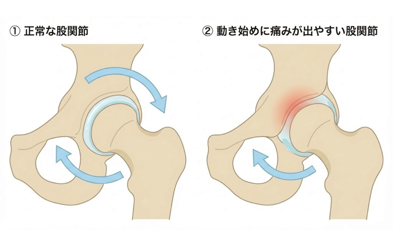 股関節の正常状態と動き始めに痛みが出やすい状態の比較図