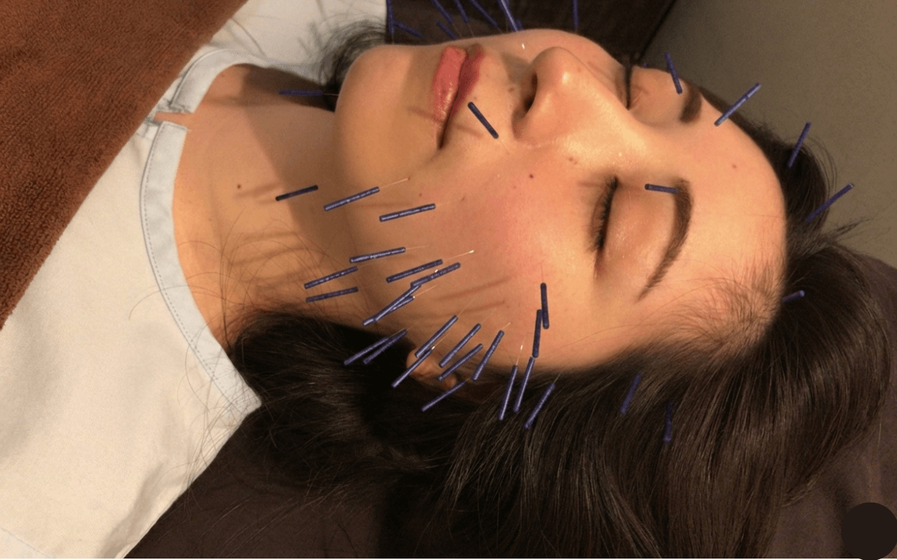 新宿で美容鍼の実績が豊富なキュアベルの施術風景。リフトアップと肌質改善に特化した、21年の経験を持つ専門家による丁寧なケア。